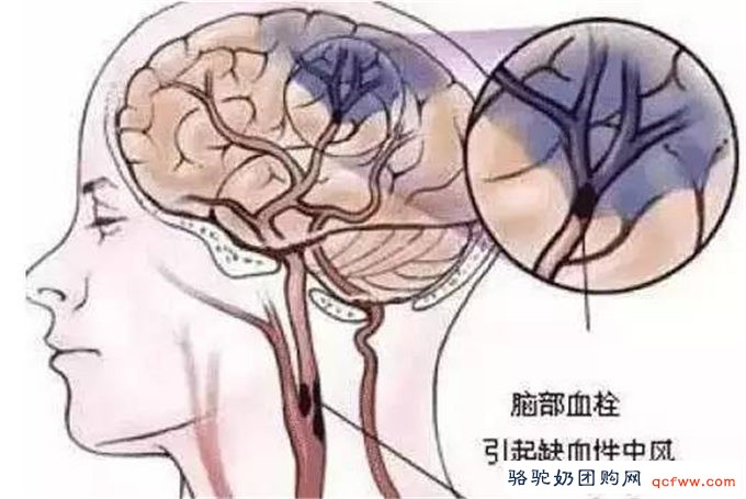 我国早有防中风防痴呆降血糖的养生方法,而且还简单