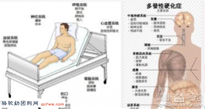 骆驼奶团购网为您提供：多发性硬化病与肠道菌群、剖腹产甚至母乳喂养的关系